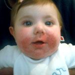 eczema-face-baby-1.jpg