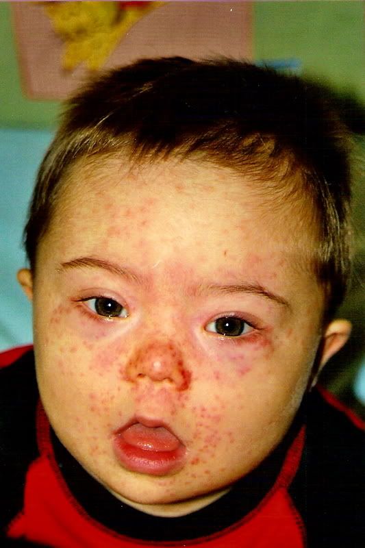 Measles Vaccine Reaction Rash