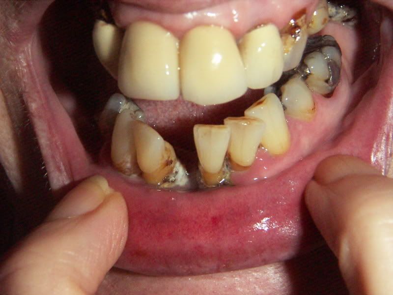 rotting gums Pictures, Images and Photos