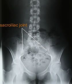 Steroid injections for si joint pain