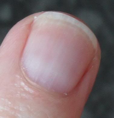 Celiac Fingernails
