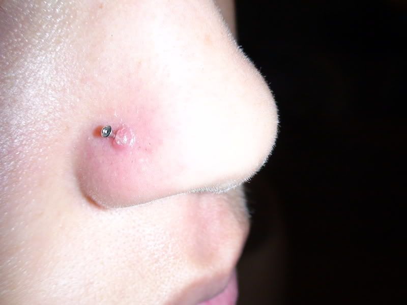 The Infamous BUMP in Nose, nostril, septum Forum Forum